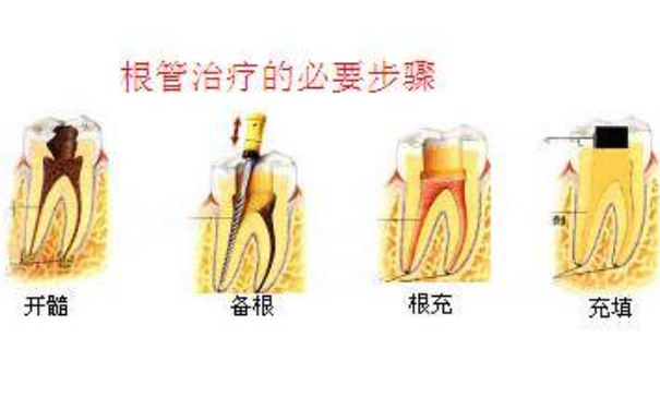 清華大學(xué)玉泉醫(yī)院口腔科牙齒根管調(diào)節(jié)怎么樣?費(fèi)用多少
